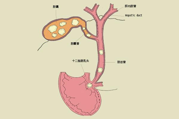 四虎免费在线观看白丝 胆囊结石手术费用大概多少（胆囊炎胆囊结石做手术要多少钱）