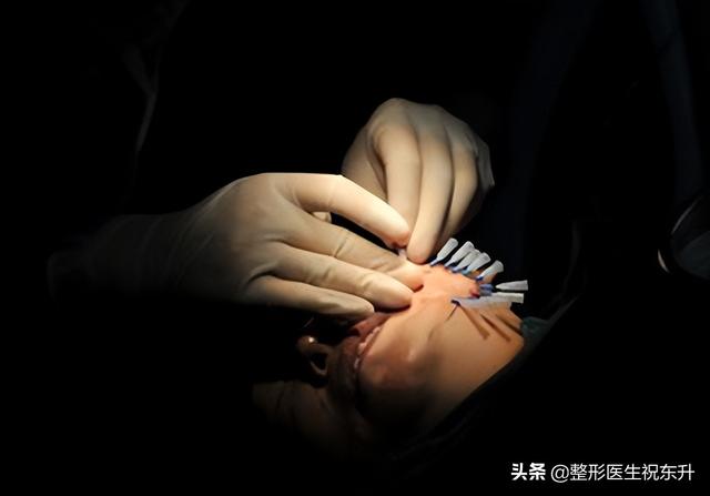 探花流出视频在线观看 提拉紧致做什么医美项目好（什么医美可以提拉紧致）